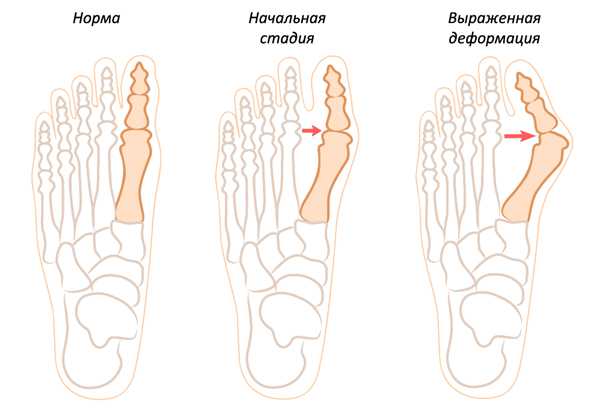 Косточки на ногах лечение астана thumbnail